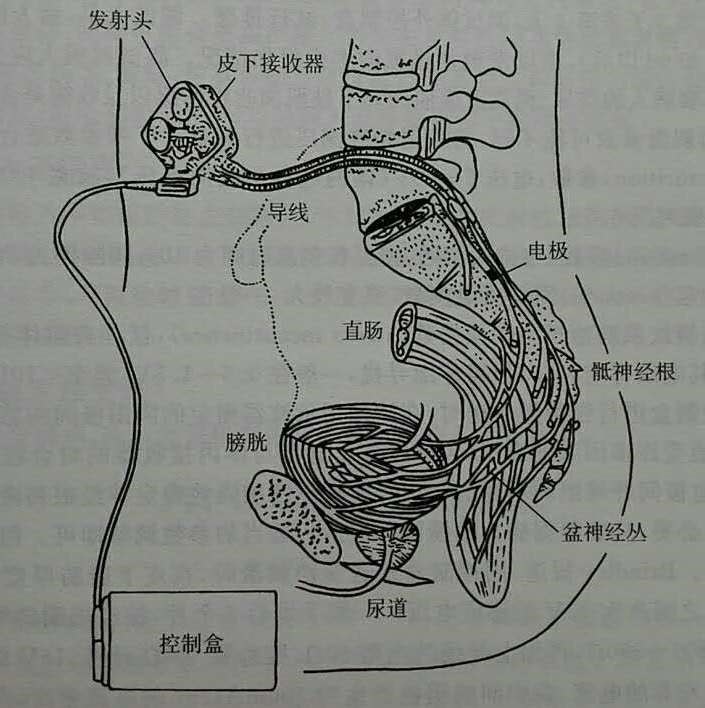 话题:脊髓损伤后上运动神经源性膀胱的自主排尿系统