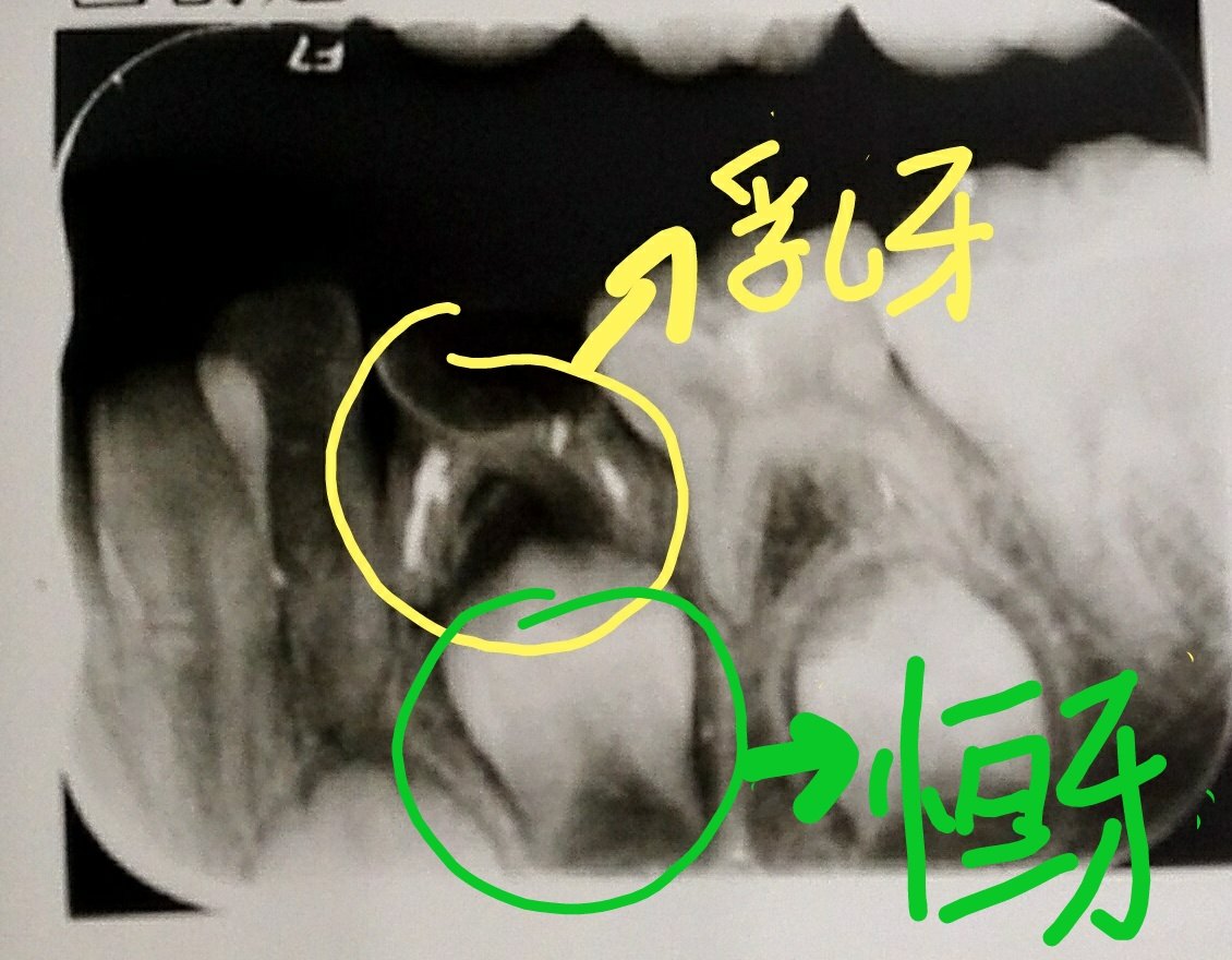 乳牙坏了影响恒牙吗?乳牙拔掉就没事了么? - 好