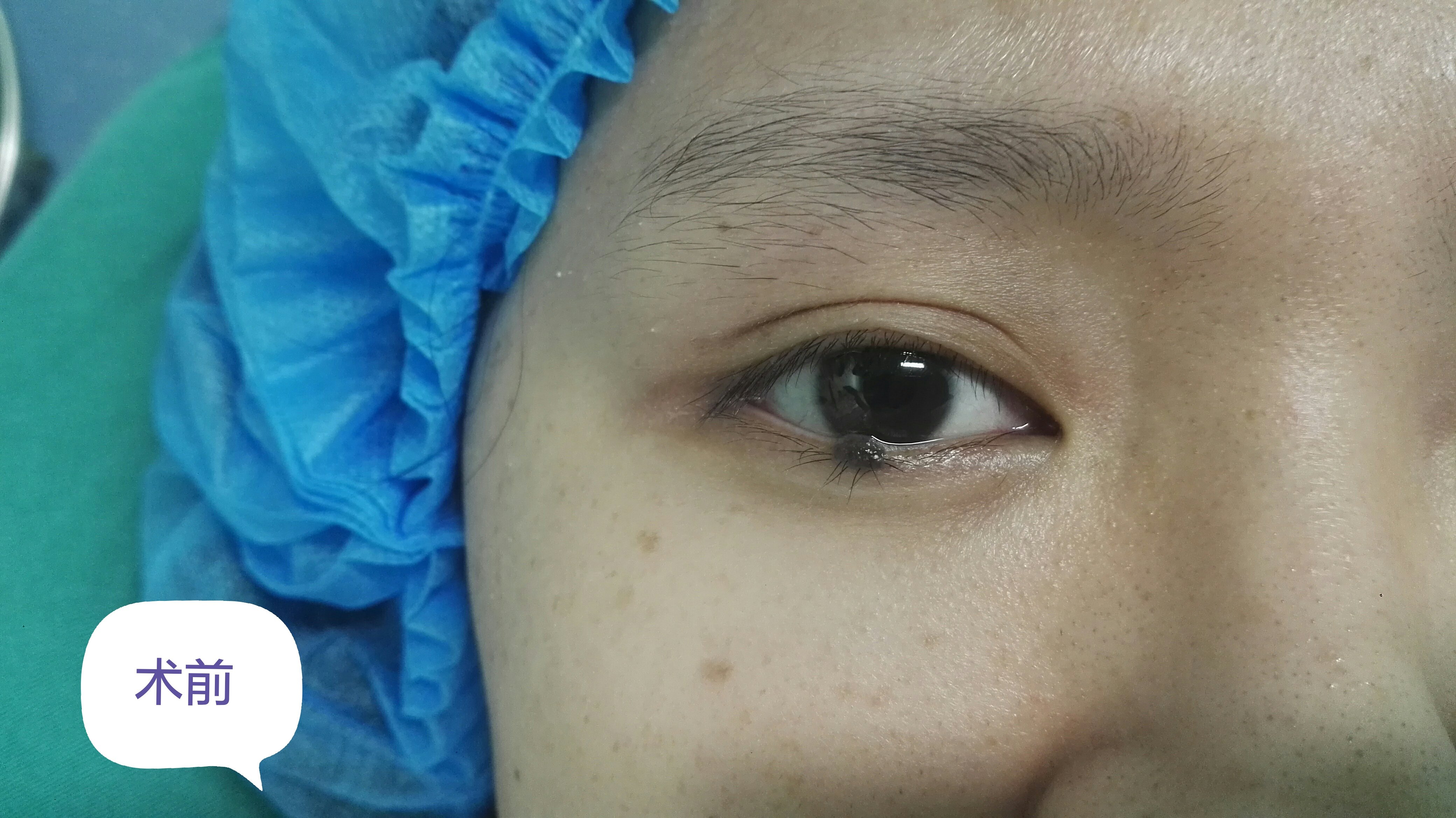 胡健 眼睑痣(1) 本文是胡健医生版权所有,未经授权请勿转载.