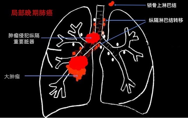 局部晚期肺癌:放疗的主战场