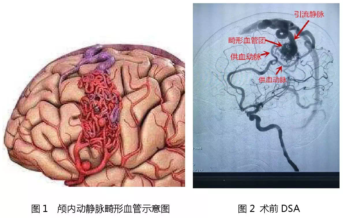 介入技术巧治脑血管畸形