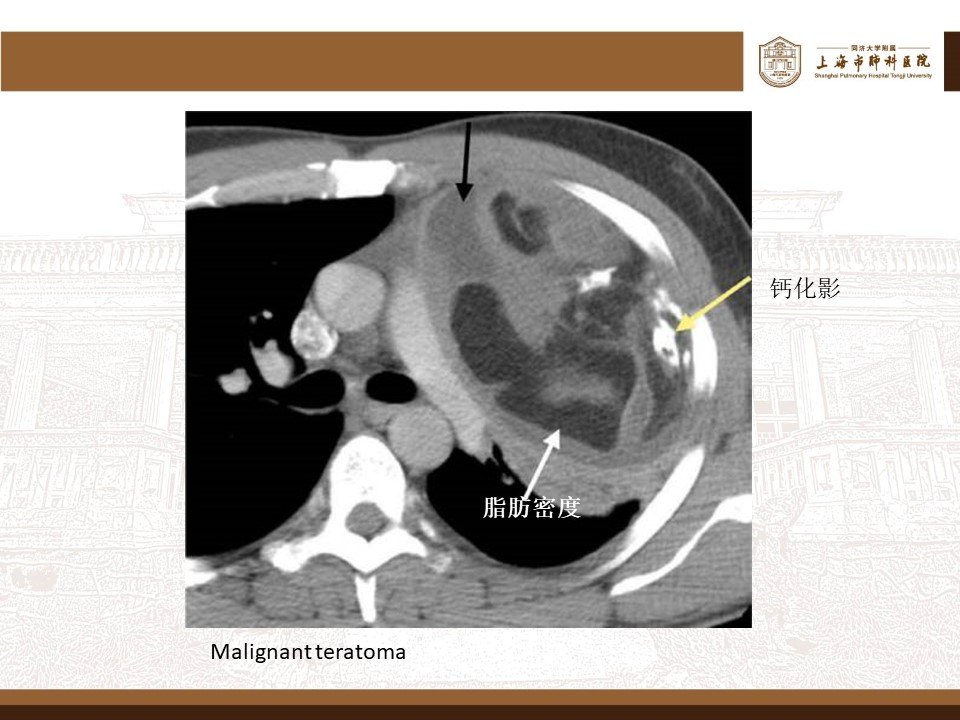 遇到纵隔畸胎瘤莫慌张