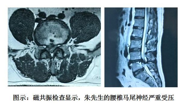 腰突症患者出现这种情况,不及时手术将抱憾终