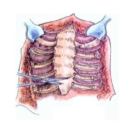 今天的鸡胸超微创手术:无管、无胸腔镜、微切