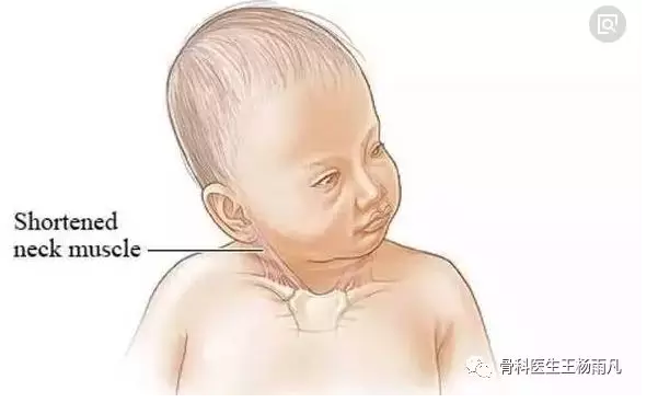 关于小儿斜颈(歪脖子)不得不说的事儿!