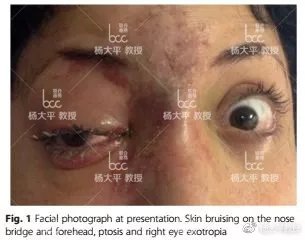 关于骨粉注射后的并发症