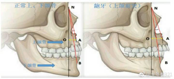 下面小哥哥就用简单通俗的配图方式为各位妹子讲一讲"龅牙(上颌前突)"