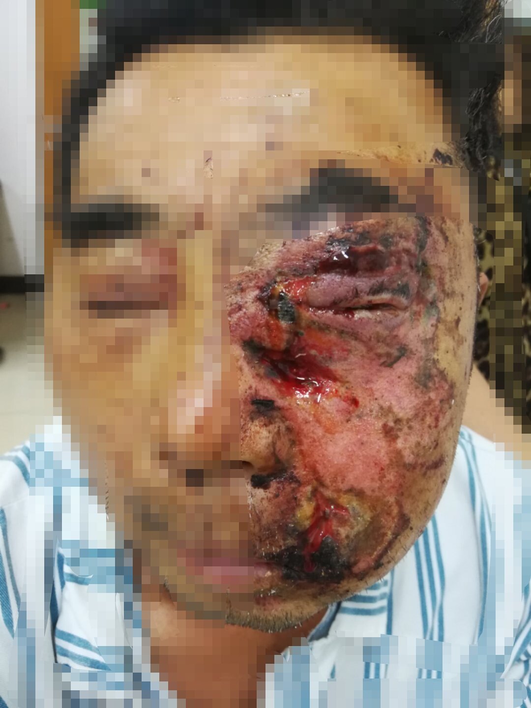 案例6. 鞭炮伤致眼球破裂,颜面皮肤裂伤,颌面部骨折