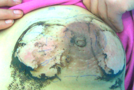 中医药治疗肉芽肿性乳腺炎案例第二章