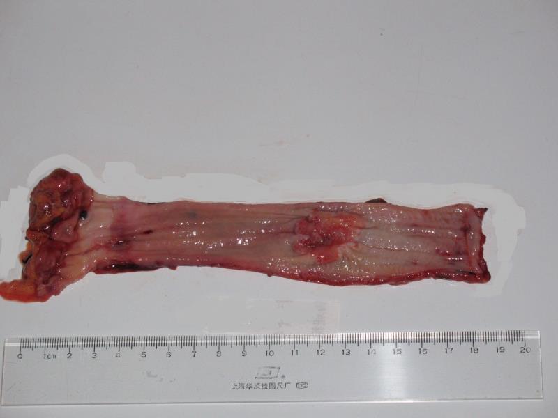食管中晚期癌(缩窄型)标本
