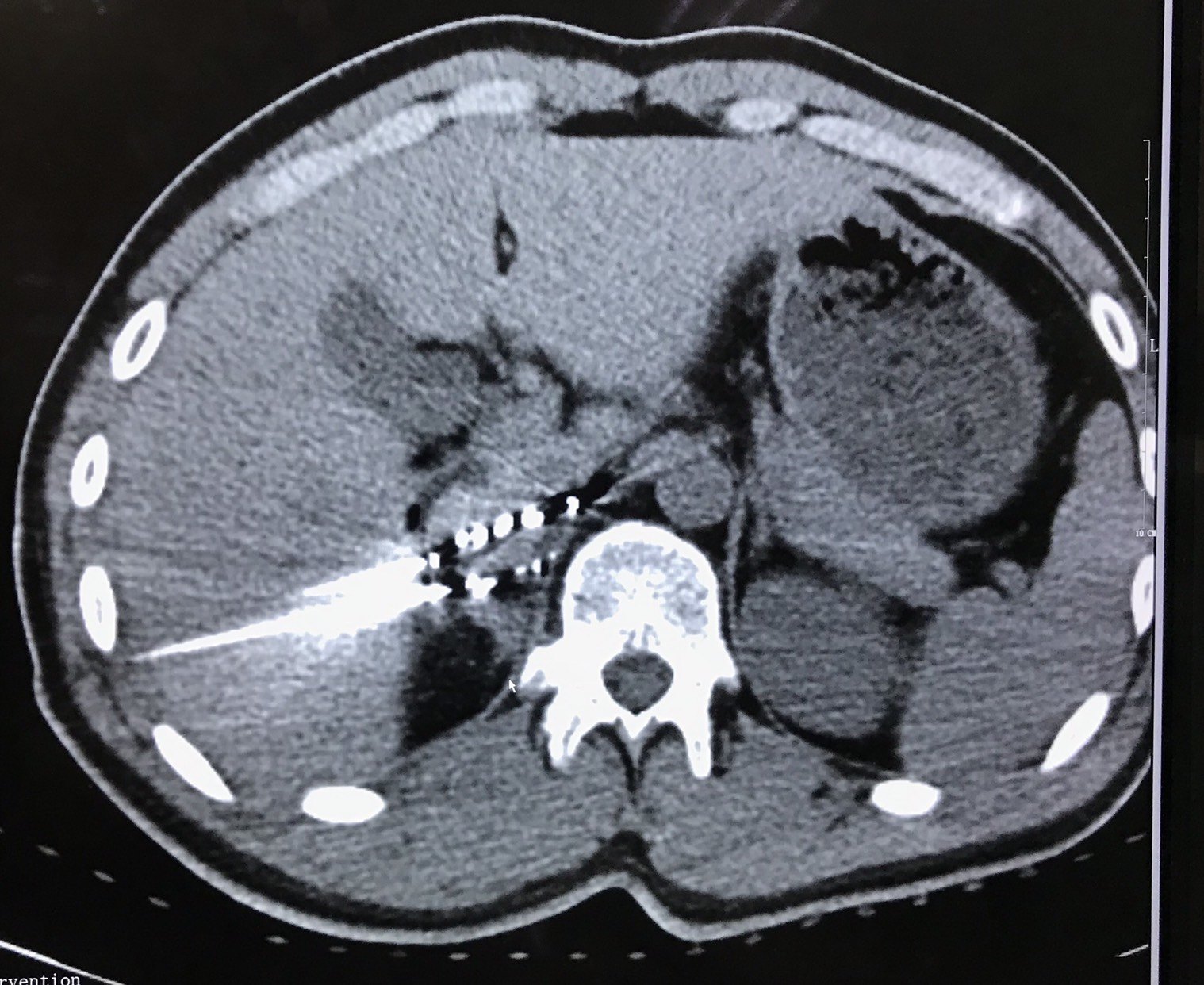 碘125放射粒子植入治疗肾上腺转移瘤
