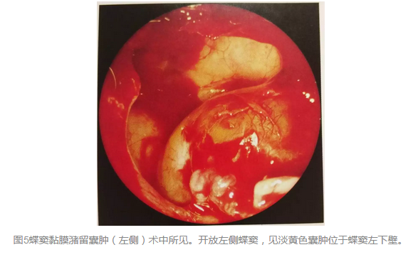 鼻窦黏膜潴留囊肿的手术方式