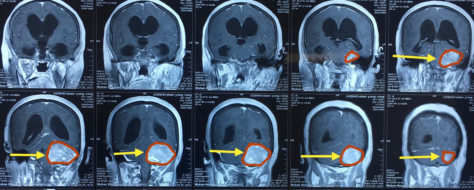 核磁共振平扫及增强,显示左侧小脑半球巨大肿瘤,边界清楚,均匀强化