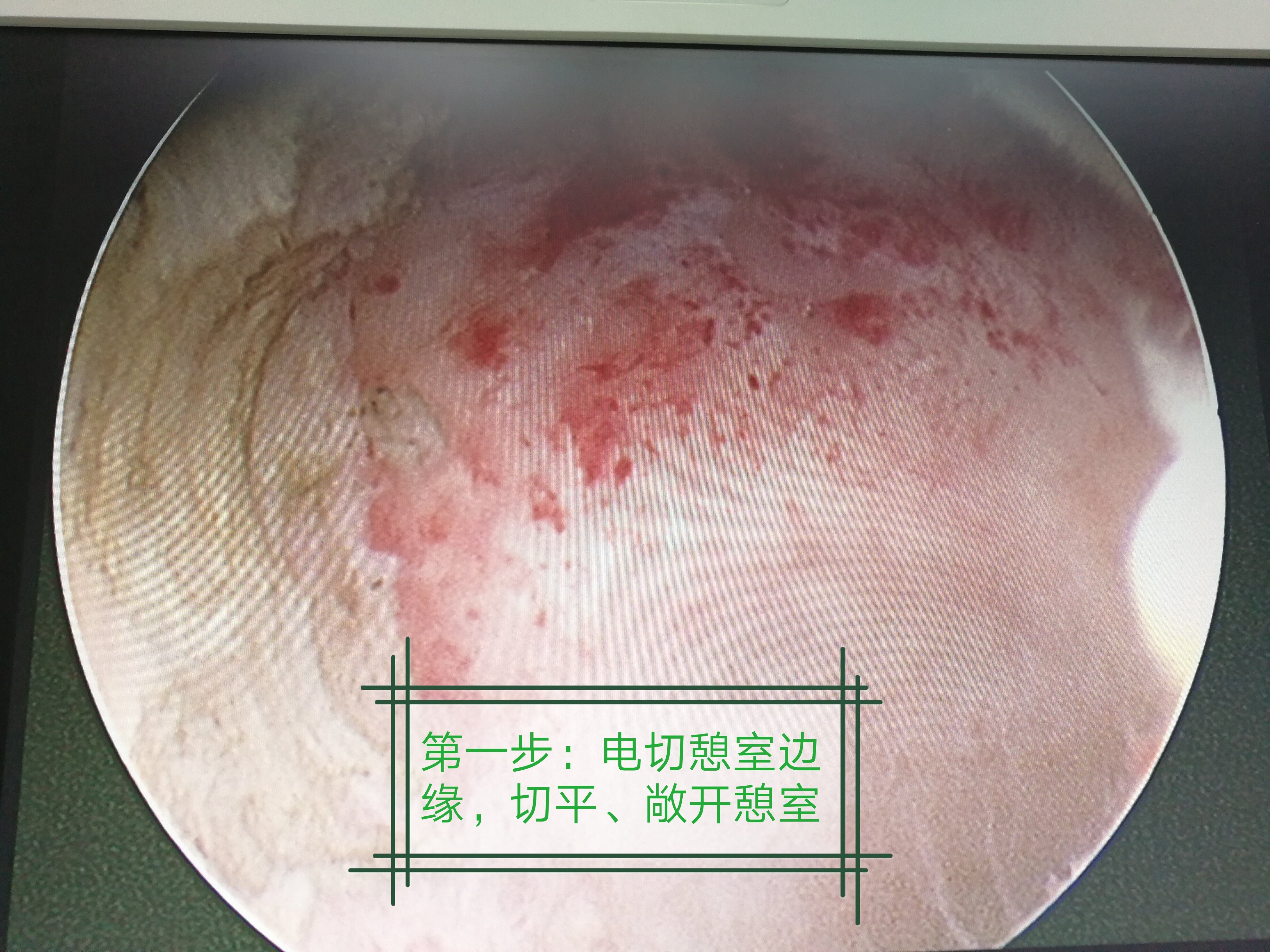 手术解析:宫腔镜下切除-剖宫产术后子宫切口憩