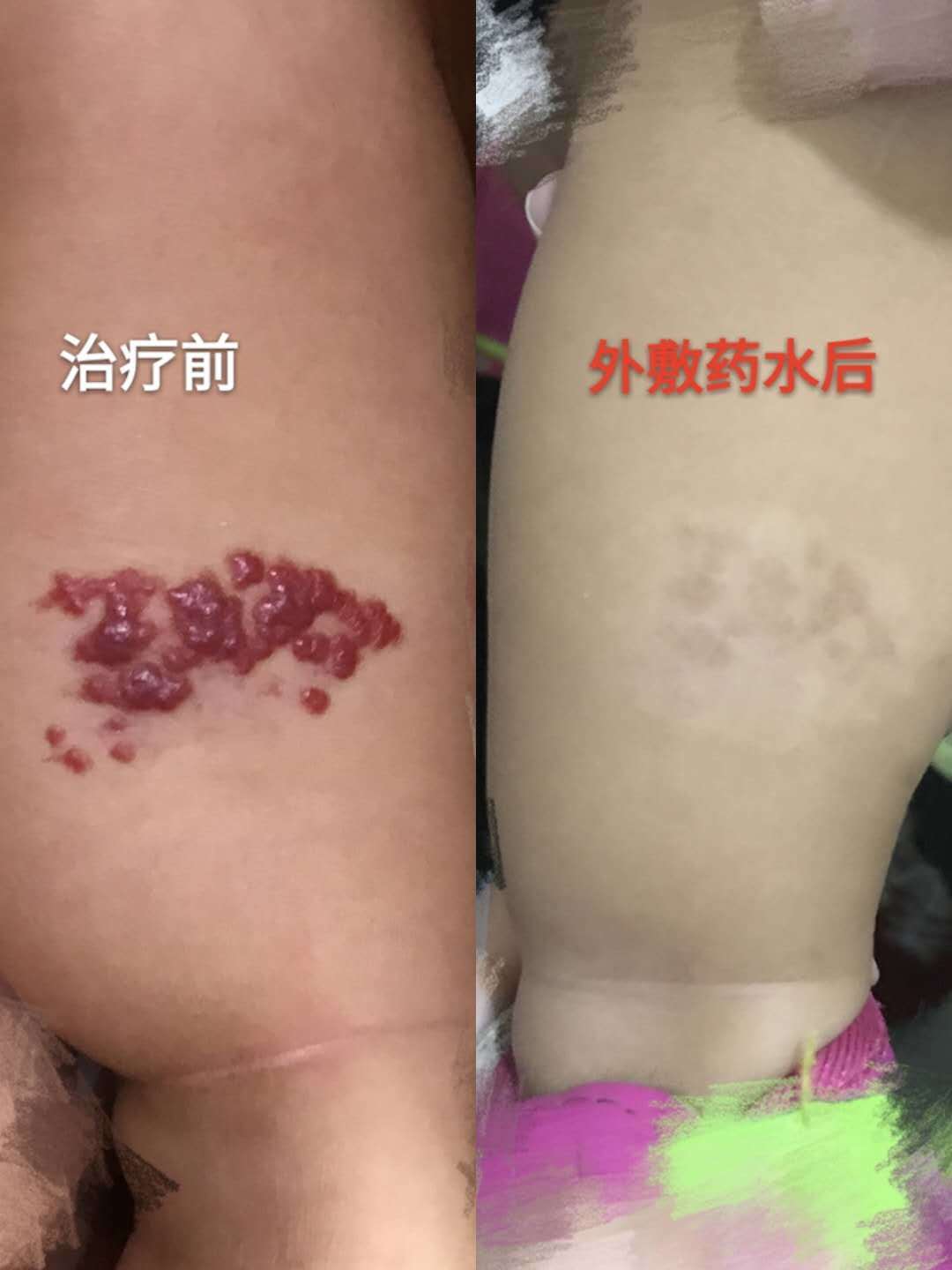 婴幼儿血管瘤微创治疗之小小眼药水治疗血管瘤