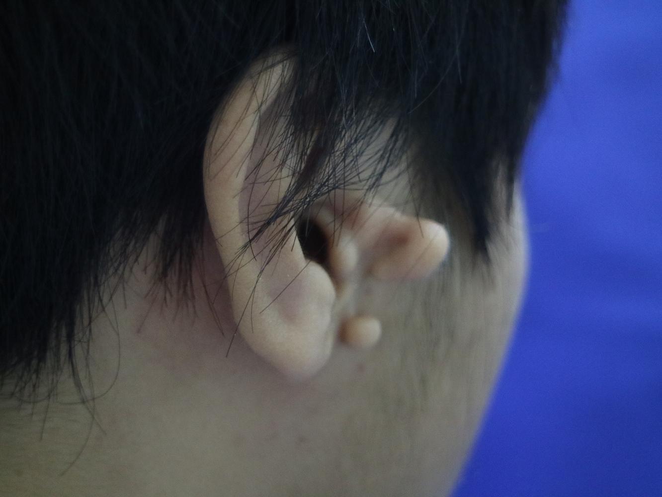 正面耳朵“隐形”的贴发耳怎样调整？贴发耳矫正术就是这么神奇！_耳部整形_耳部整形治疗介绍 - 好大夫在线