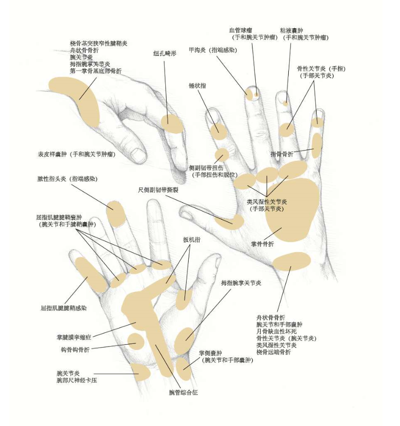 常见手腕关节疼痛及可能疾病示意图