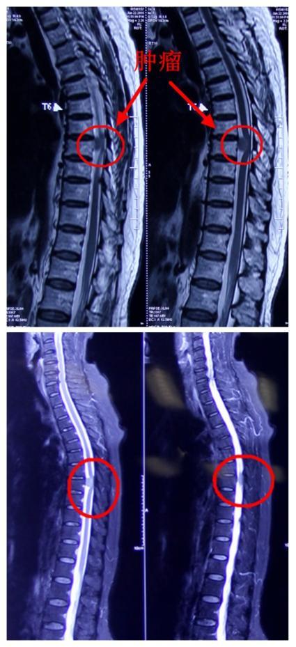 病例手术治愈胸椎管内脊膜瘤一例