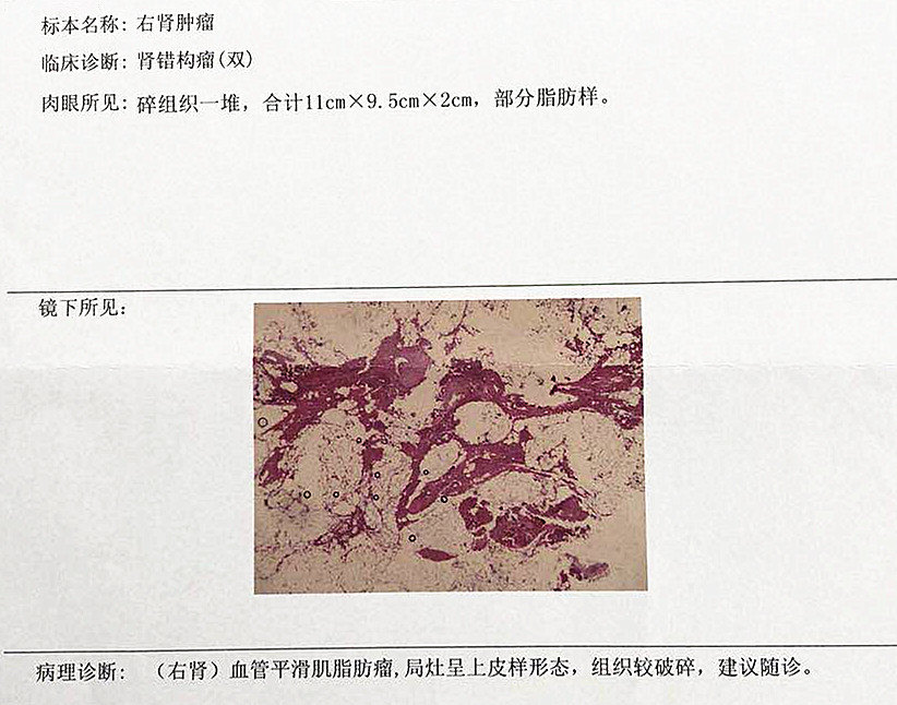 肾错构瘤的保肾治疗