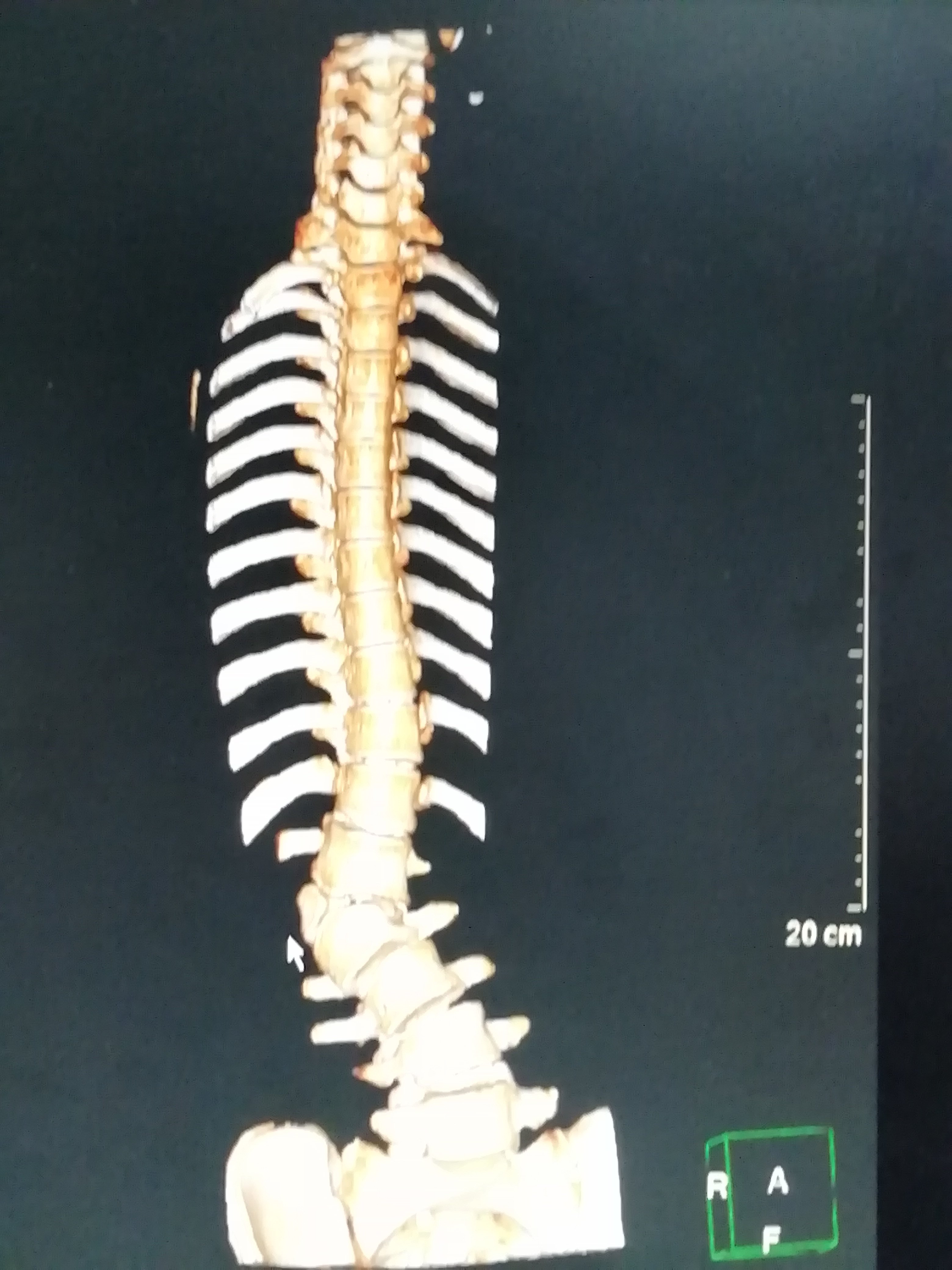 先天性腰椎半椎体伴脊柱侧后凸手术半椎体切除