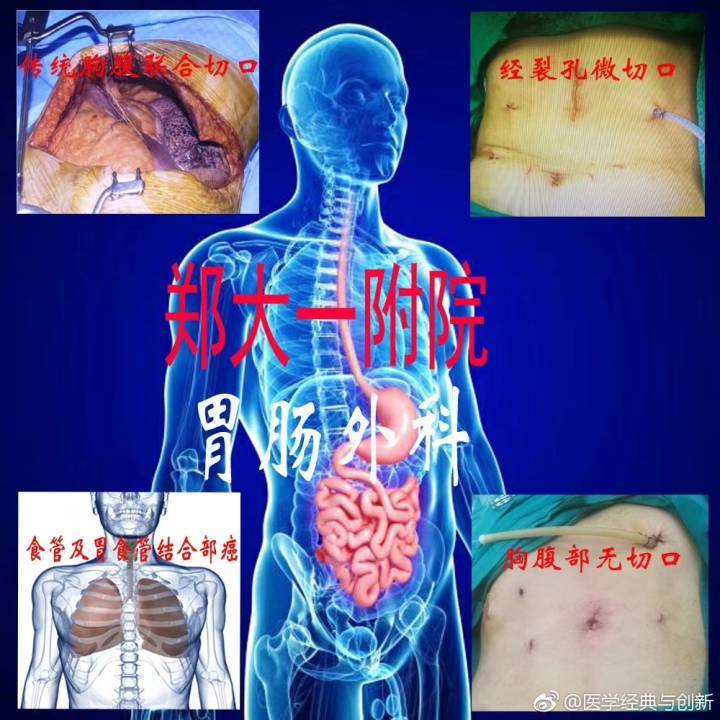 坚持技术与理论创新胃肠外科进入亚微外科与膜解剖新时代