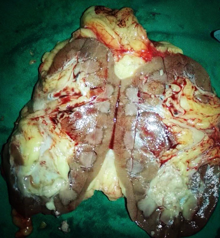 腹腔镜肾切除\/部分切除术(肿瘤性、无功能肾、