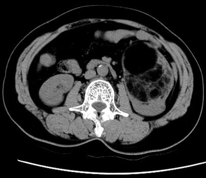 腹腔镜肾切除\/部分切除术(肿瘤性、无功能肾、