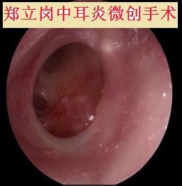 郑立岗中耳乳突炎微创手术第654江苏南通崇川