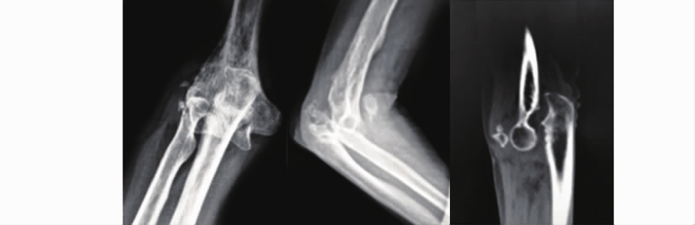 自体髂骨重建冠状突治疗陈旧性肘关节脱位一例