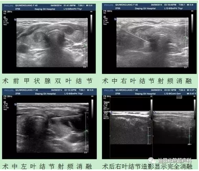 超声引导下甲状腺结节射频消融治疗 好大夫在线