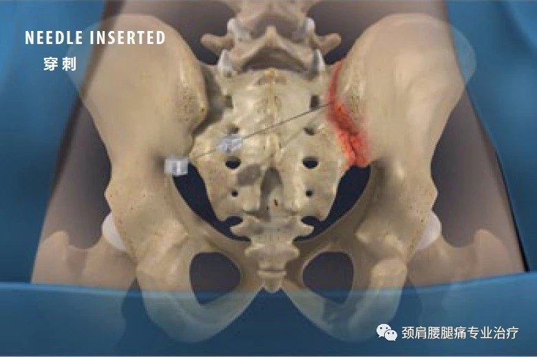 骶髂关节炎注射治疗图解