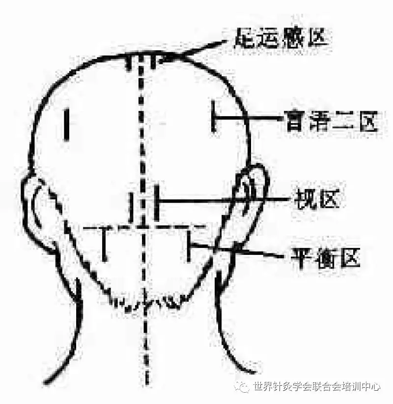 针灸名家焦顺发头针的临床研究