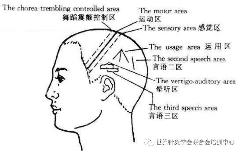 针灸名家焦顺发头针的临床研究