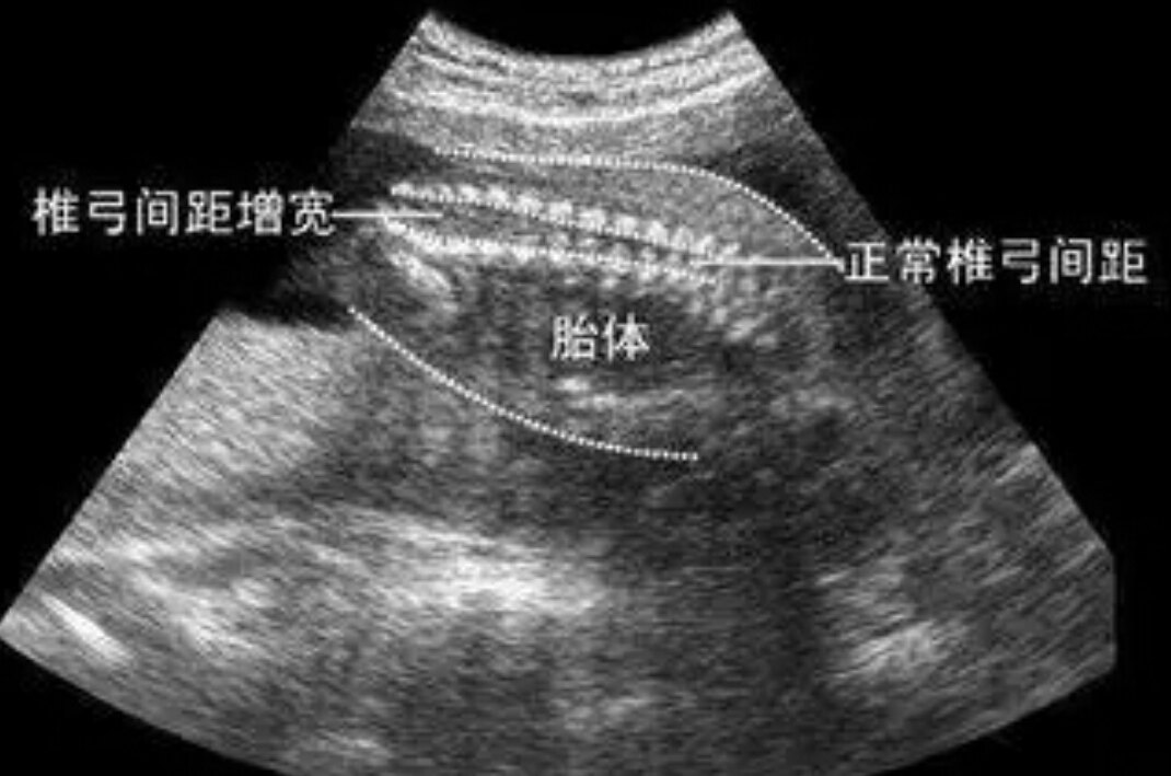 孕妇16-18周出现自觉胎动，再次排除胎儿畸形