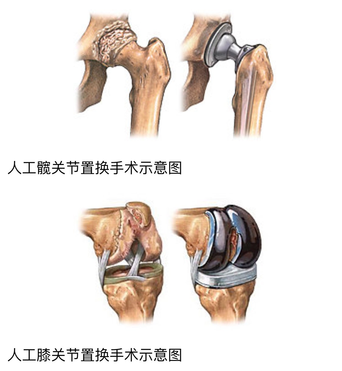 人工关节置换手术是通过切除关节面破损的骨与软骨组织,然后安装一套