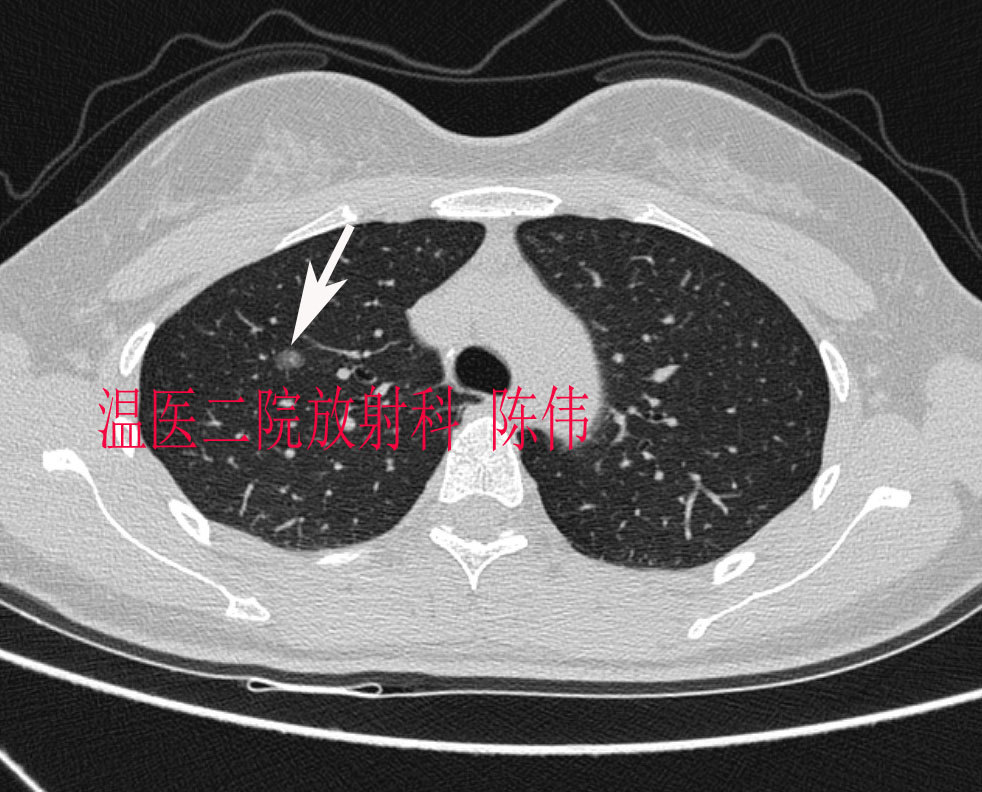 4例肺癌的典型影像学表现