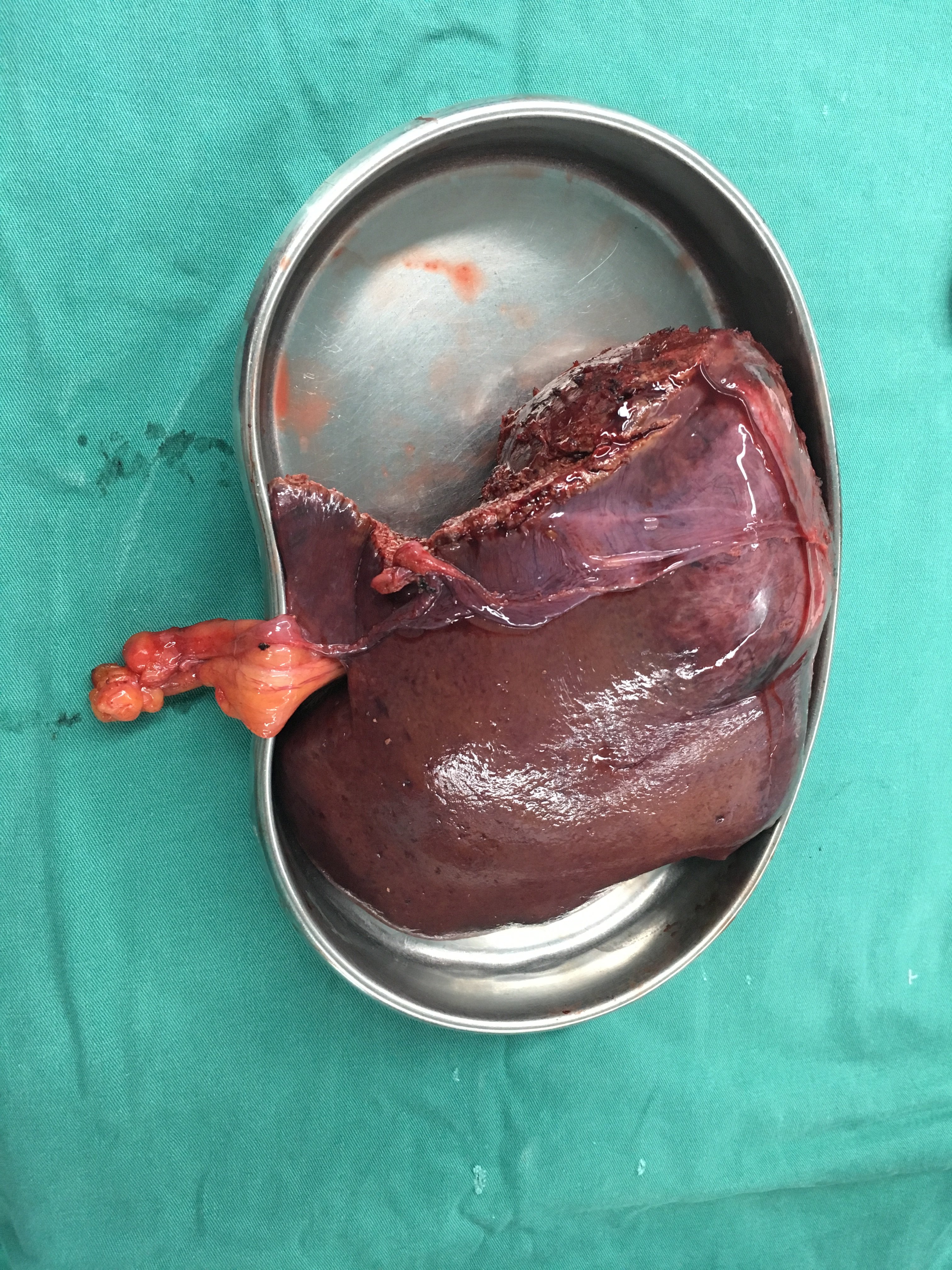 肝脏第四段大肿瘤压迫肝中静脉行左半肝切除