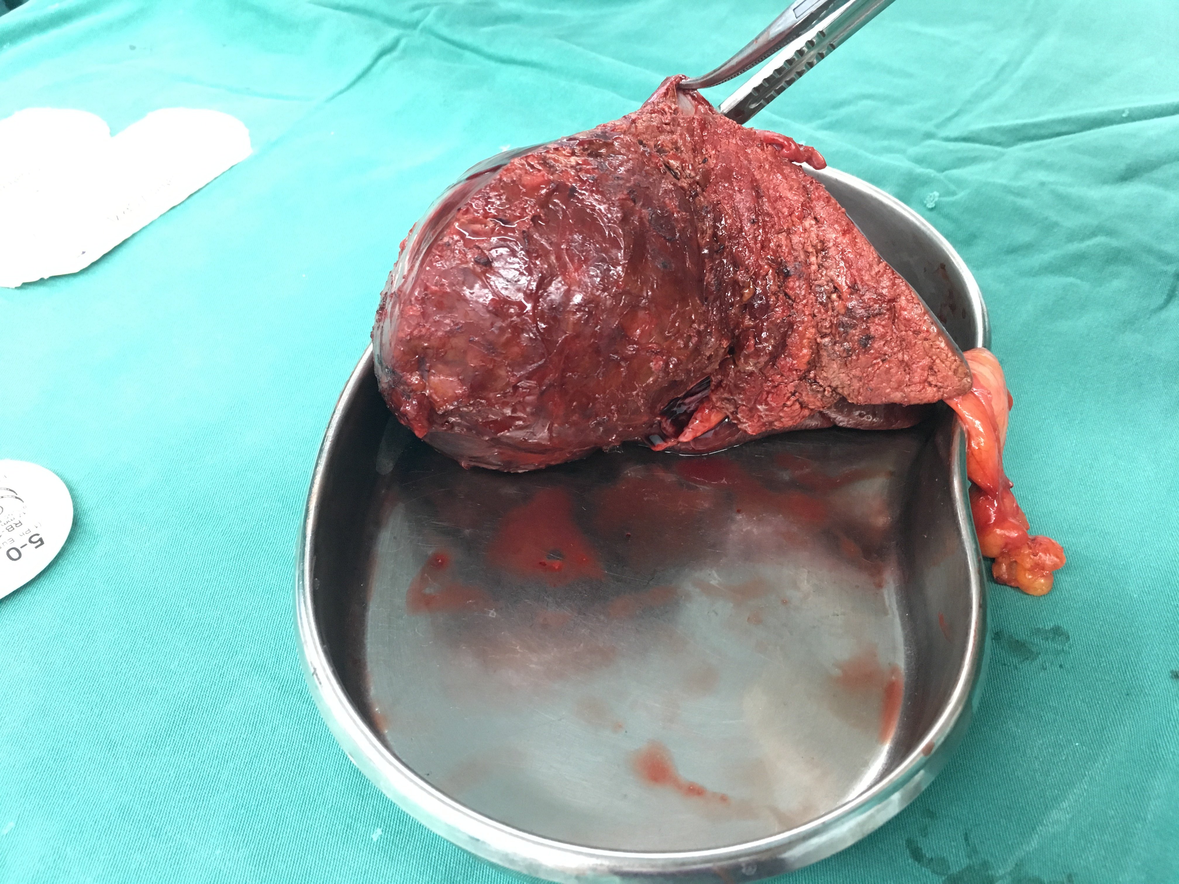 肝脏第四段大肿瘤压迫肝中静脉行左半肝切除