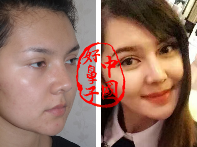 隆鼻骨粉成炸弹成就中国好鼻子