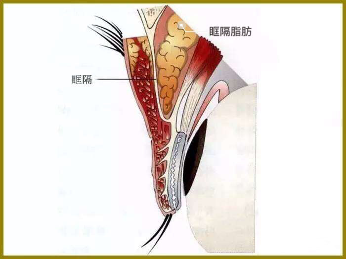 李斌斌手术实例—眶隔脂肪重置,上睑凹陷矫正详解及案例