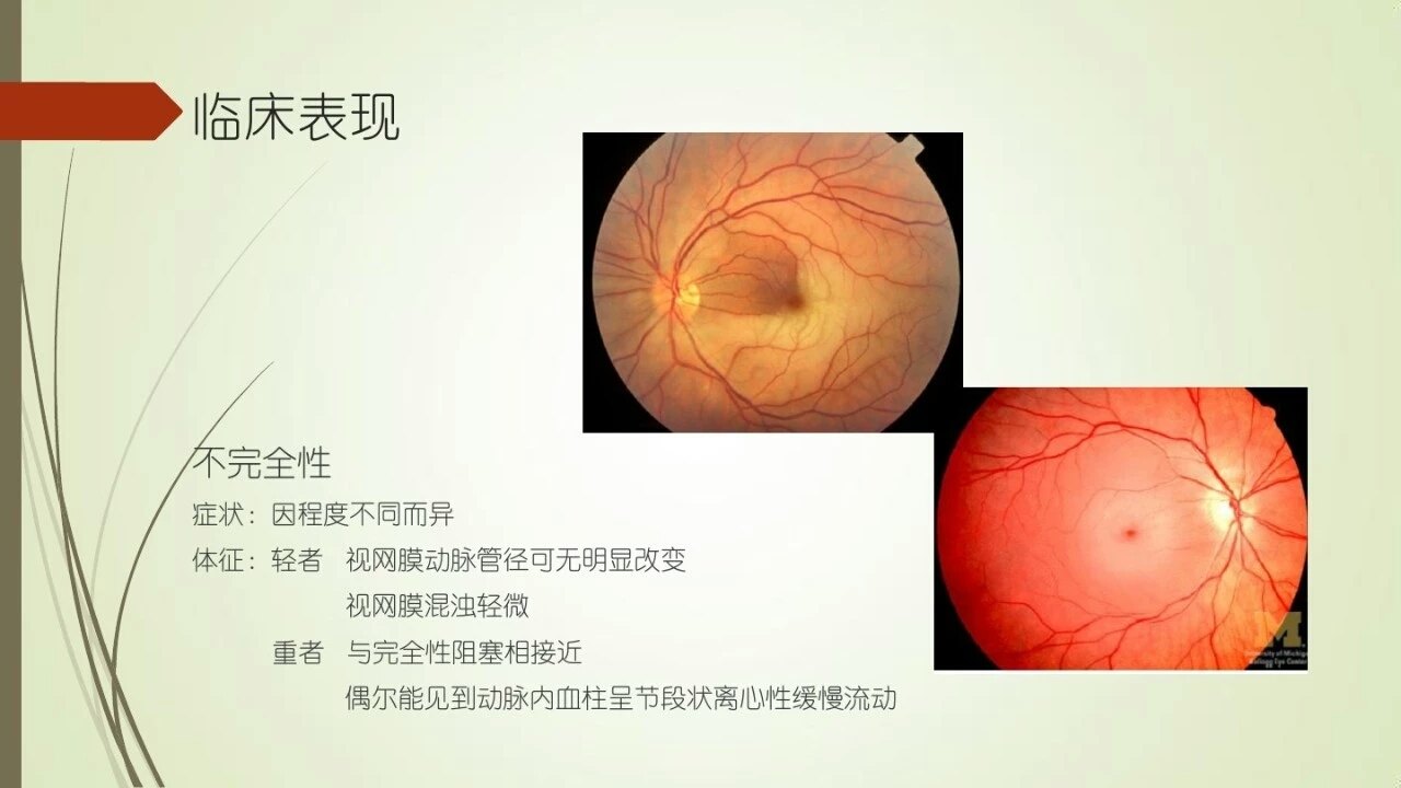 视网膜中央动脉阻塞内附ppt图26张