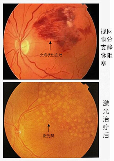 哪些患者需要做眼底激光治疗