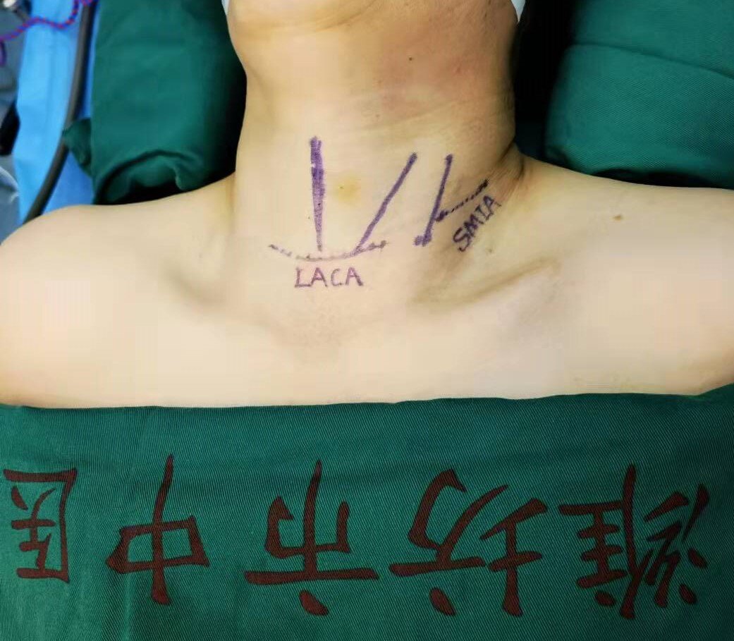 甲状腺手术微创,美容的新选择-颈部侧方入路