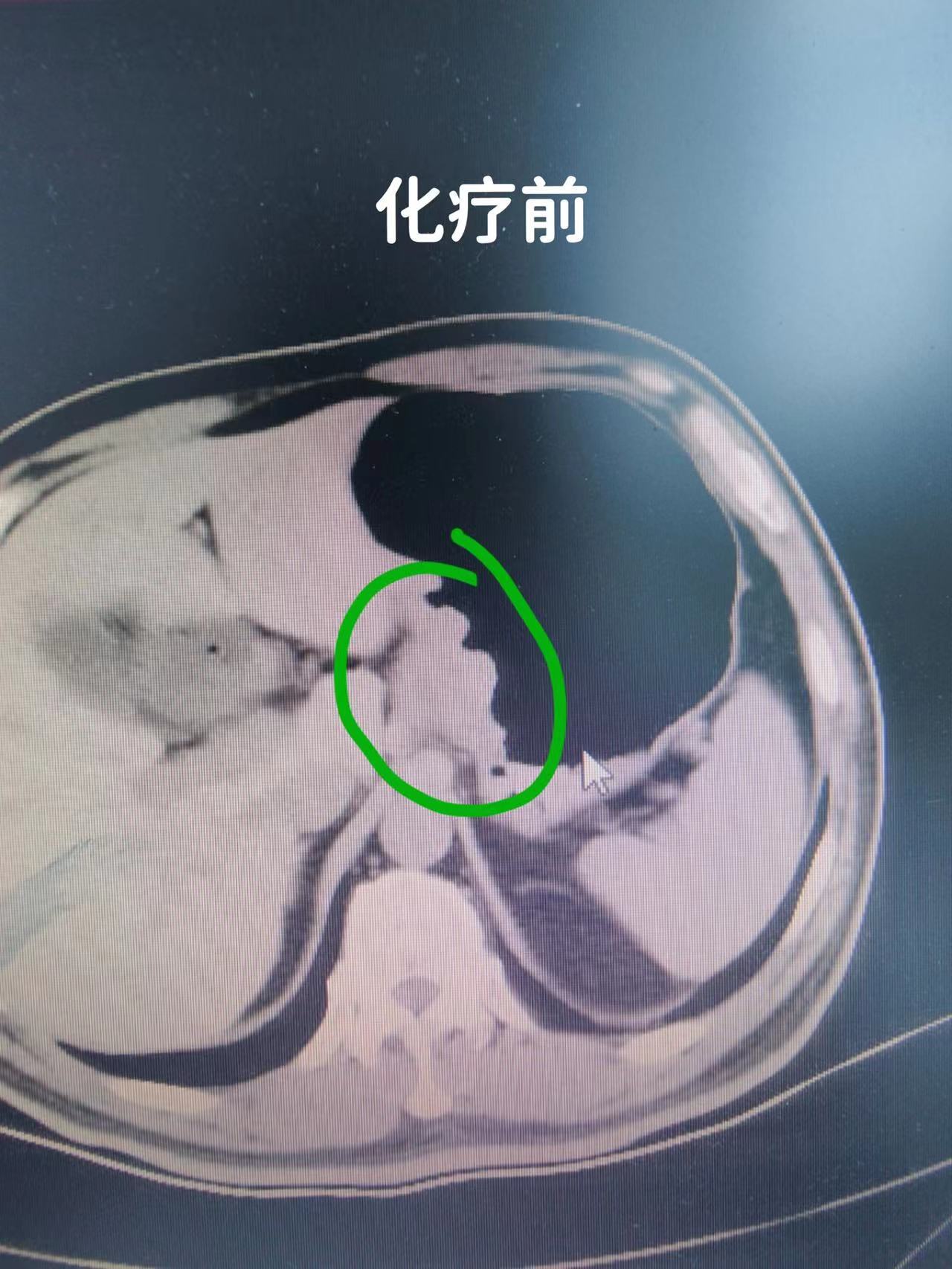 一例胃穿孔患者紧急救治的案例分享