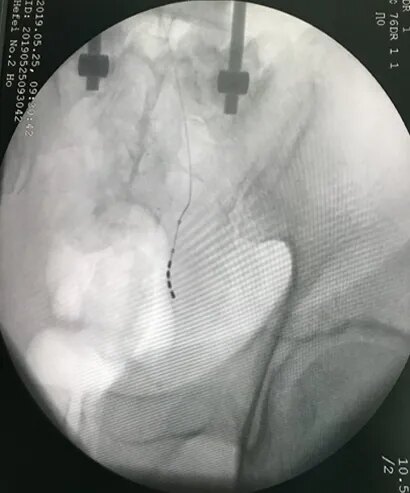 手术直击小小膀胱起搏器解决6年排尿障碍大问题