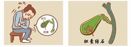 同仁堂最好的胆结石药_胆结石偏方_偏方治大病------名医用偏方纪实