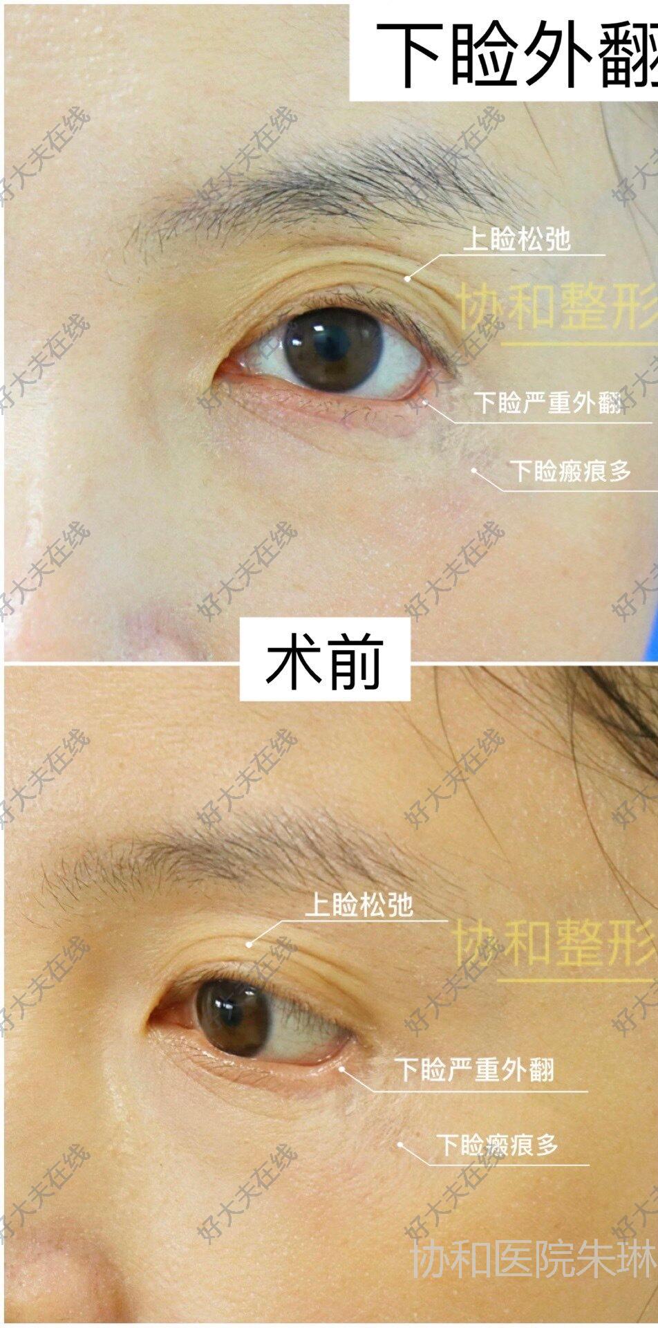 下睑外翻_睑外翻 好大夫在线