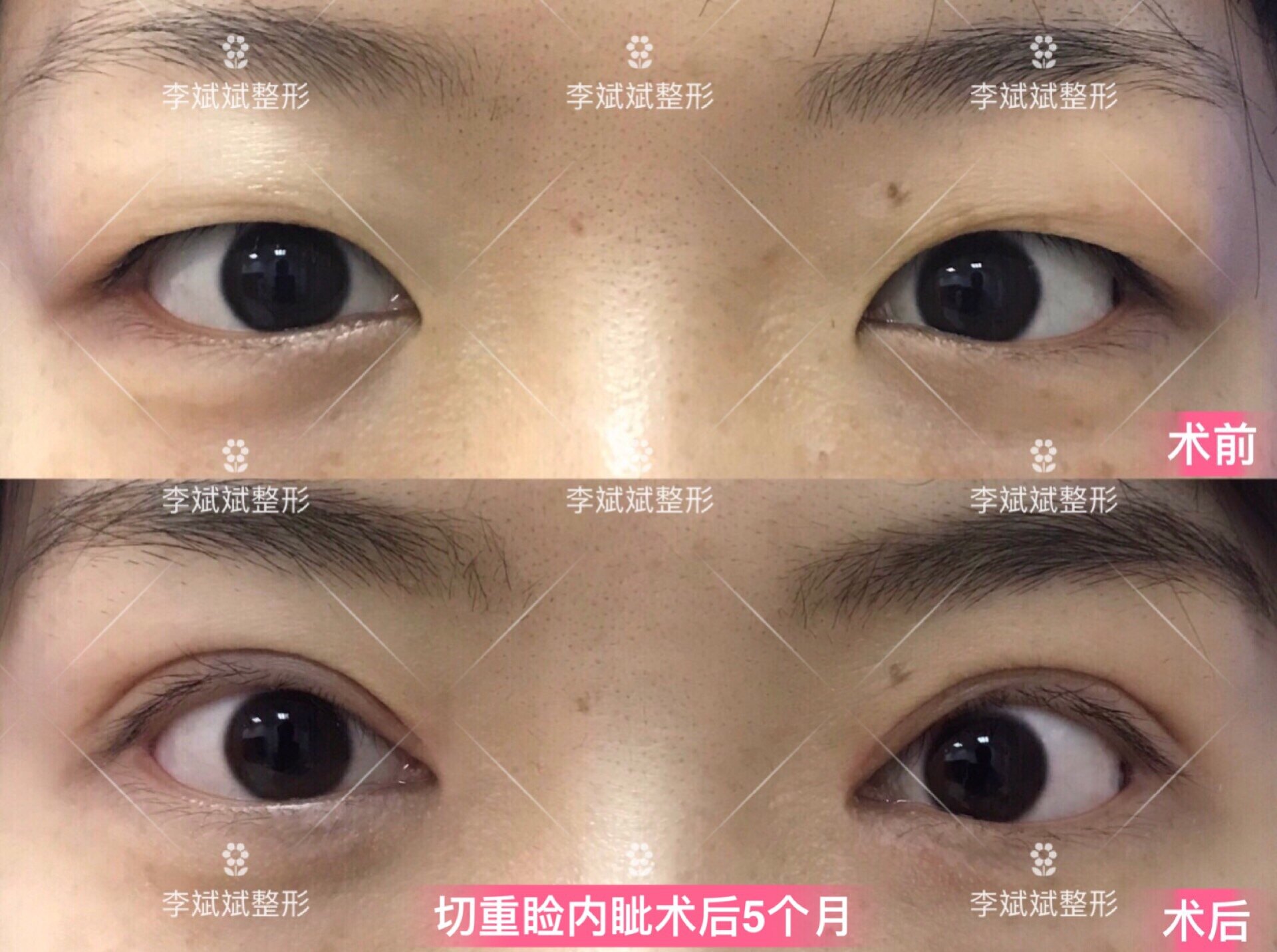 开外眼角前后对比图_开眼角图片前后对比_开眼角前后对比图片