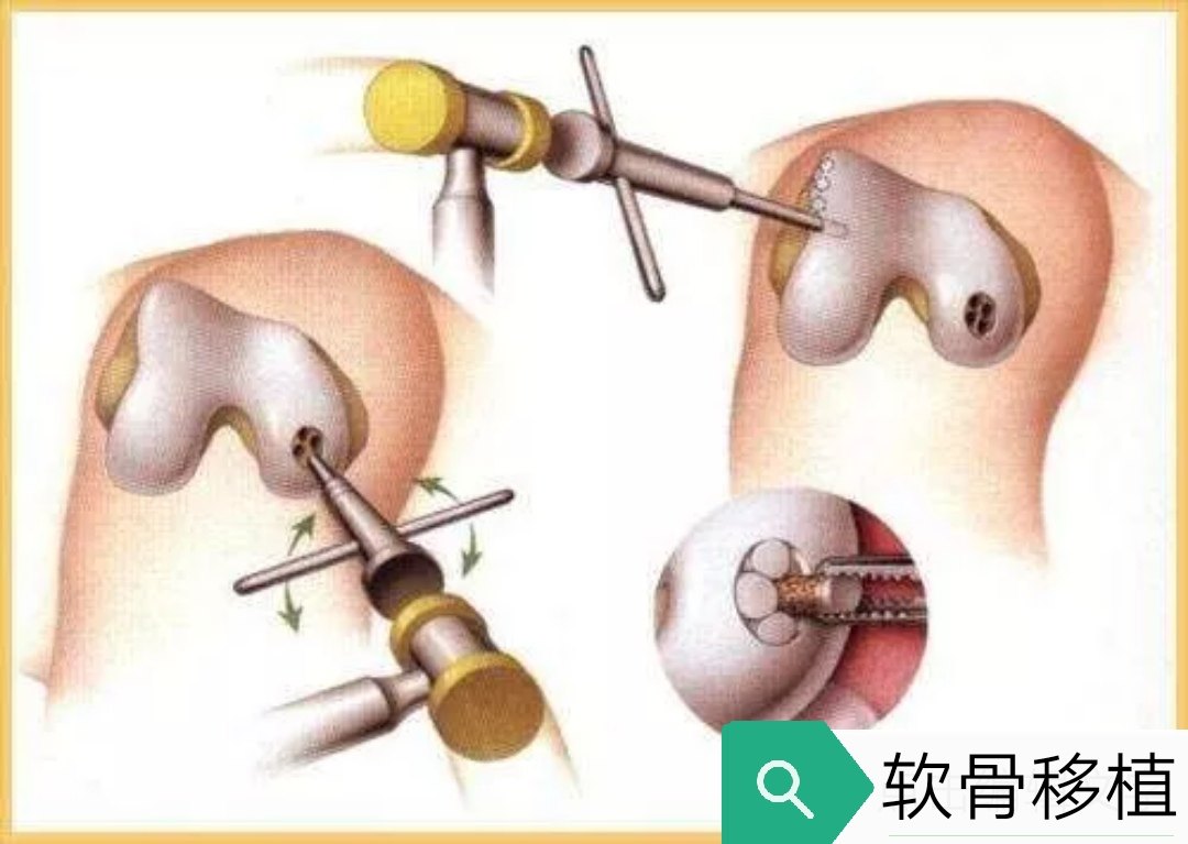 软骨磨损了还能治吗?