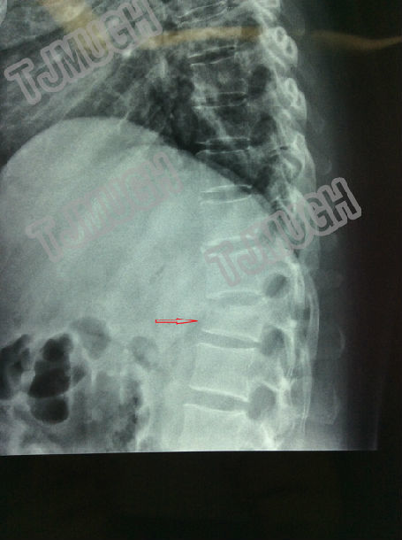 术前ct结果如下,图中箭头所示为 骨折 的胸12椎体,伴有椎管狭窄,脊髓